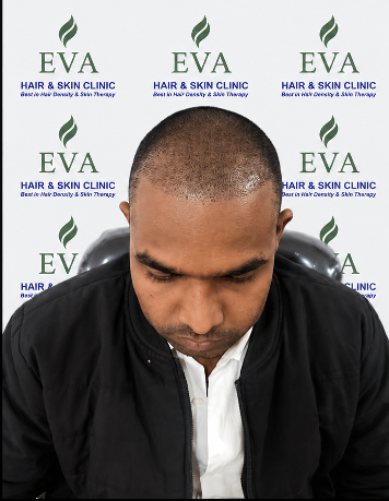 Before hair transplant result 4